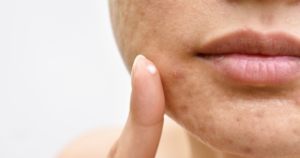 Comment se débarrasser de l’acné adulte